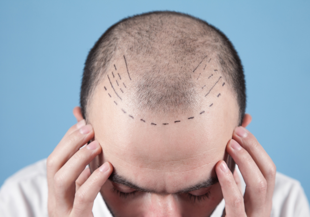 Best Hair Transplantation Clinic In Kphb Colony