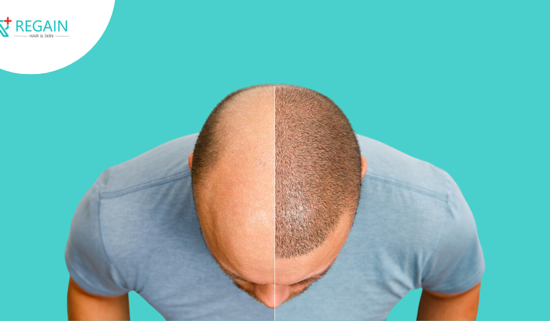 Transform Your Look: The Best Hair Transplant Clinics in KPHB Colony!